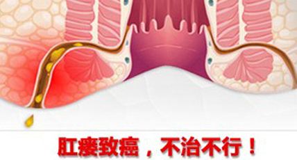 分而治之巧解肛瘘诸难题 广州东大肛肠医院黑吗?
