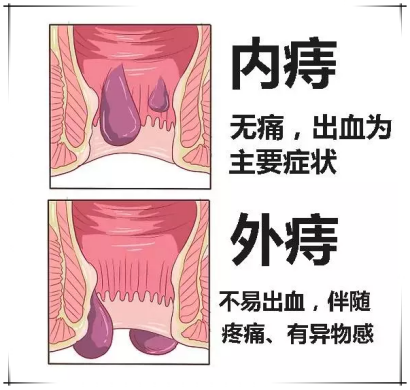 广州东大肛肠医院——痔疮.jpg
