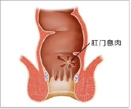 广州东大肛肠医院——肛门息肉.jpg