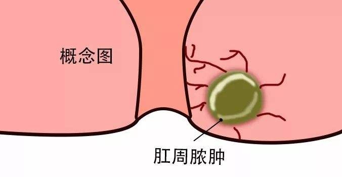 广州东大肛肠医院——肛周脓肿.jpg