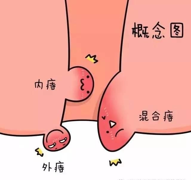 广州东大肛肠医院——痔疮.jpg